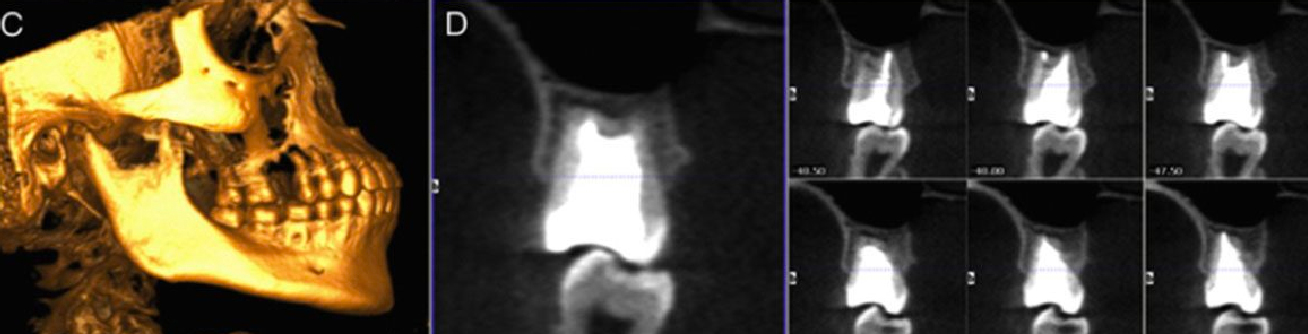 Tomografía computarizada de rayo cónico (CBCT) en ortodoncia.