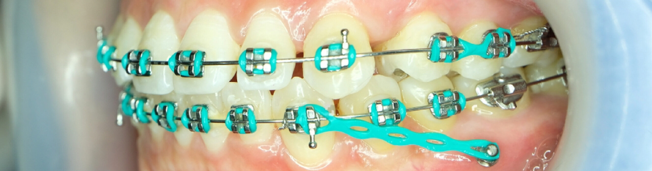 Dispositivos temporales de anclaje y las fuerzas y efectos en la dentalidad y estructuras circundantes durante un tratamiento de ortodoncia.